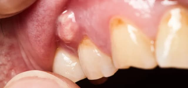 Objawy ropowicy dna jamy ustnej: jak rozpoznać i uniknąć poważnych powikłań