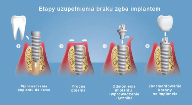Jak wygląda implant zęba? Wszystko o budowie i procesie wszczepiania Jak wygląda implant zęba? Wszystko o budowie i procesie wszczepiania