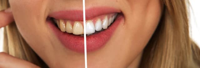 Jak wybielić zęby u dentysty – metody, efekty i co musisz wiedzieć przed zabiegiem Jak wybielić zęby u dentysty – metody, efekty i co musisz wiedzieć przed zabiegiem